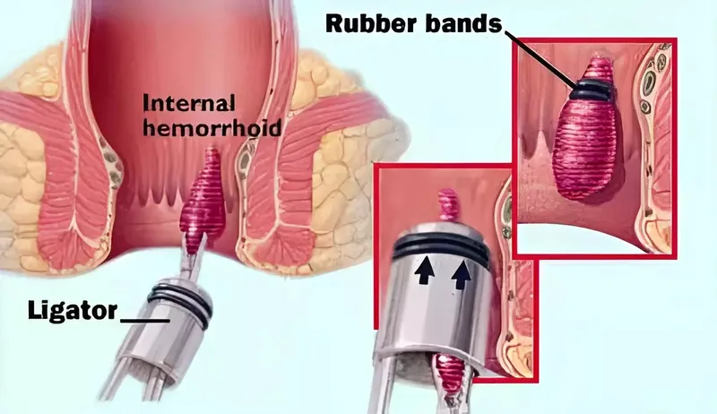 Trĩ vòng gây ra những cơn đau kéo dài và nhiều biến chứng nguy hiểm nếu không điều trị sớm
