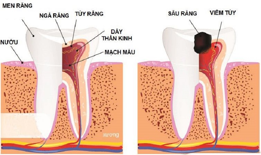 Sâu răng là nguyên nhân hàng đầu gây viêm tủy răng