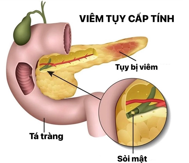 Viêm tụy là tình trạng tuyến tụy bị viêm, về lâu dài sẽ gây biến chứng nguy hiểm