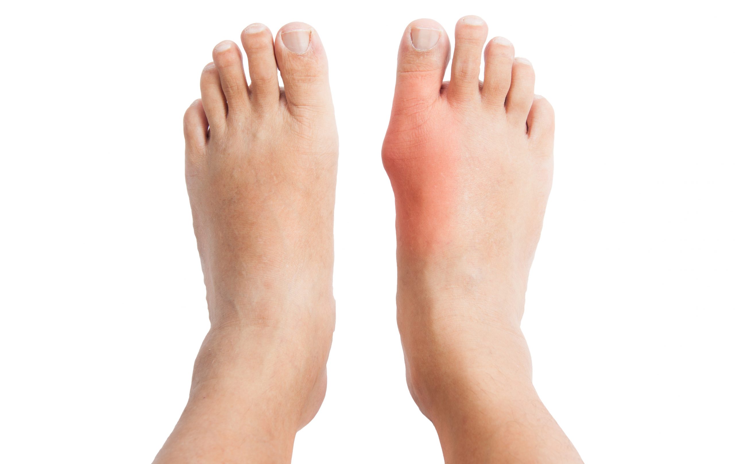 Cơn đau do bệnh gout cấp tính thường đi kèm triệu chứng nóng đỏ, sưng tấy