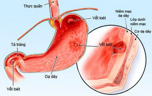 Viêm loét dạ dày- tá tràng gây xuất huyết tiêu hóa