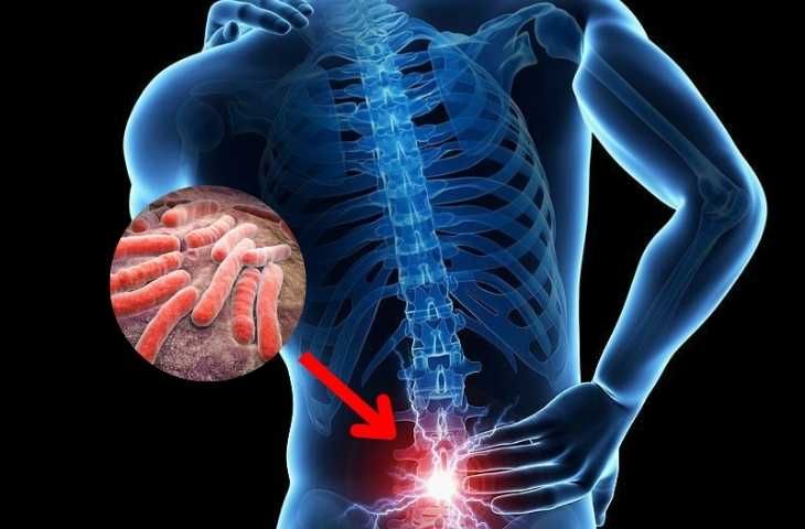 Làm thế nào để phòng ngừa và điều trị hiệu quả bệnh lao cột sống