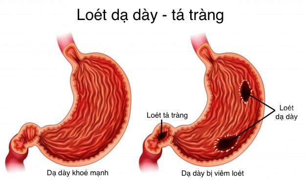 Loét dạ dày tá tràng: Triệu chứng, nguyên nhân và điều trị