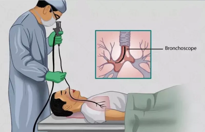Cách tối ưu để tầm soát nguy cơ ung thư phổi