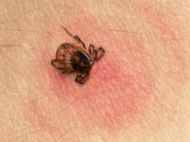 Bệnh Lyme là một bệnh nhiễm trùng do vi khuẩn Borrelia burgdorferi gây ra