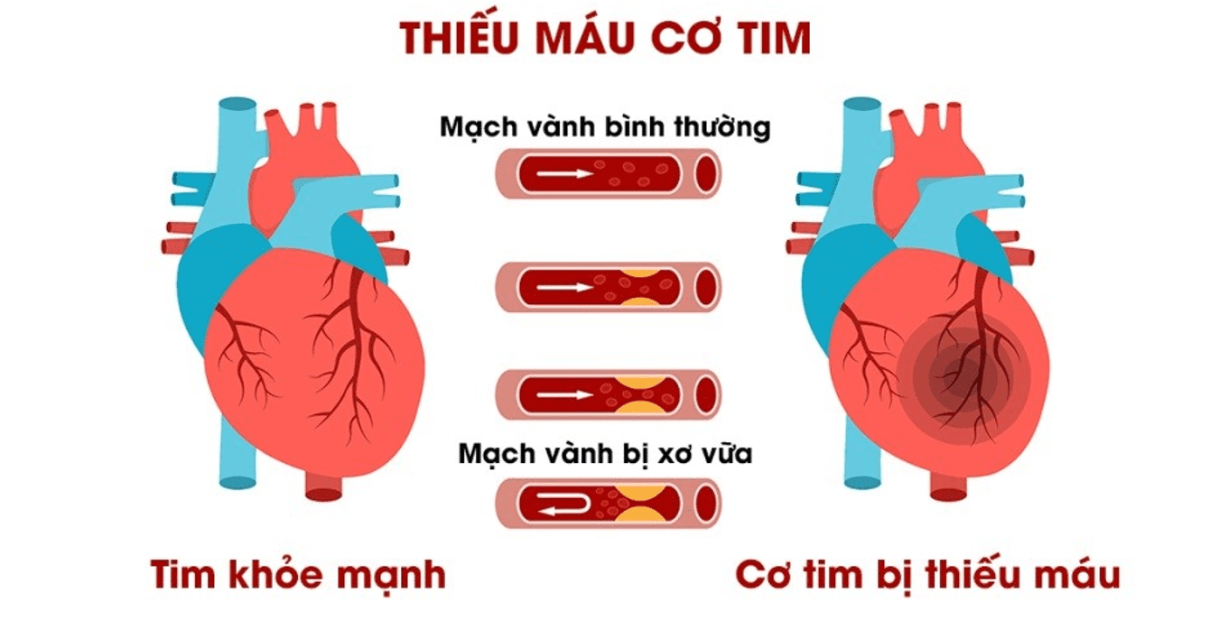 Mảng xơ vữa phát triển lớn dần trong mạch vành gây thiếu máu cơ tim