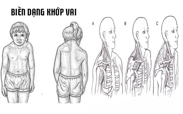 Khi có dấu hiệu biến dạng khớp vai, bạn cần thăm khám bác sĩ ngay lập tức