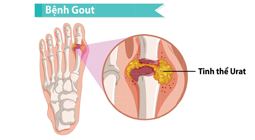 Người đang mắc bệnh gout cần làm xét nghiệm acid uric máu