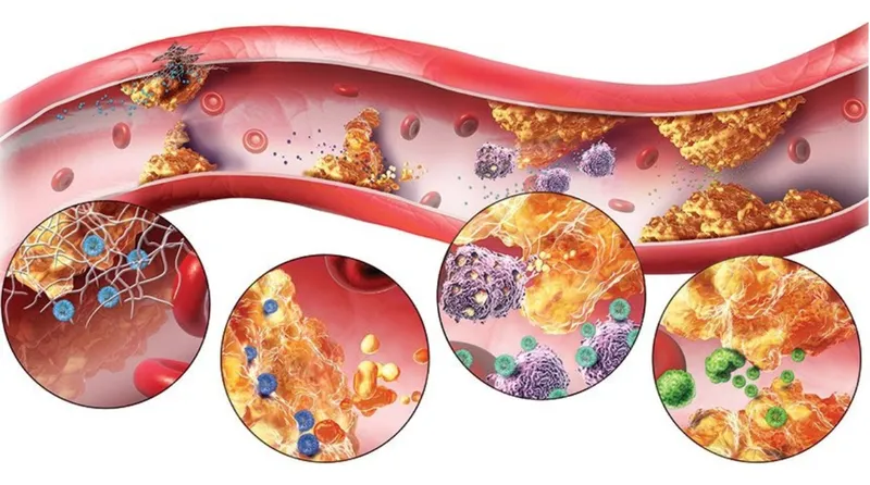 LDL cholesterol có thể tích tụ trong thành mạch và gây xơ vữa động mạch
