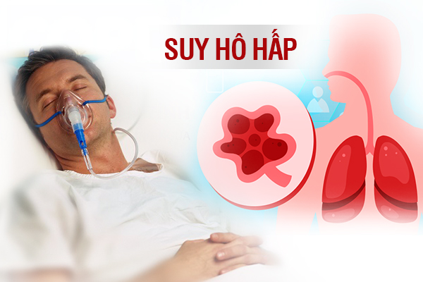 Suy hô hấp là biến chứng của viêm khí màng phổi