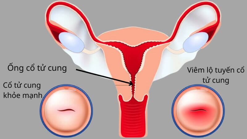 Viêm lộ tuyến cổ tử cung