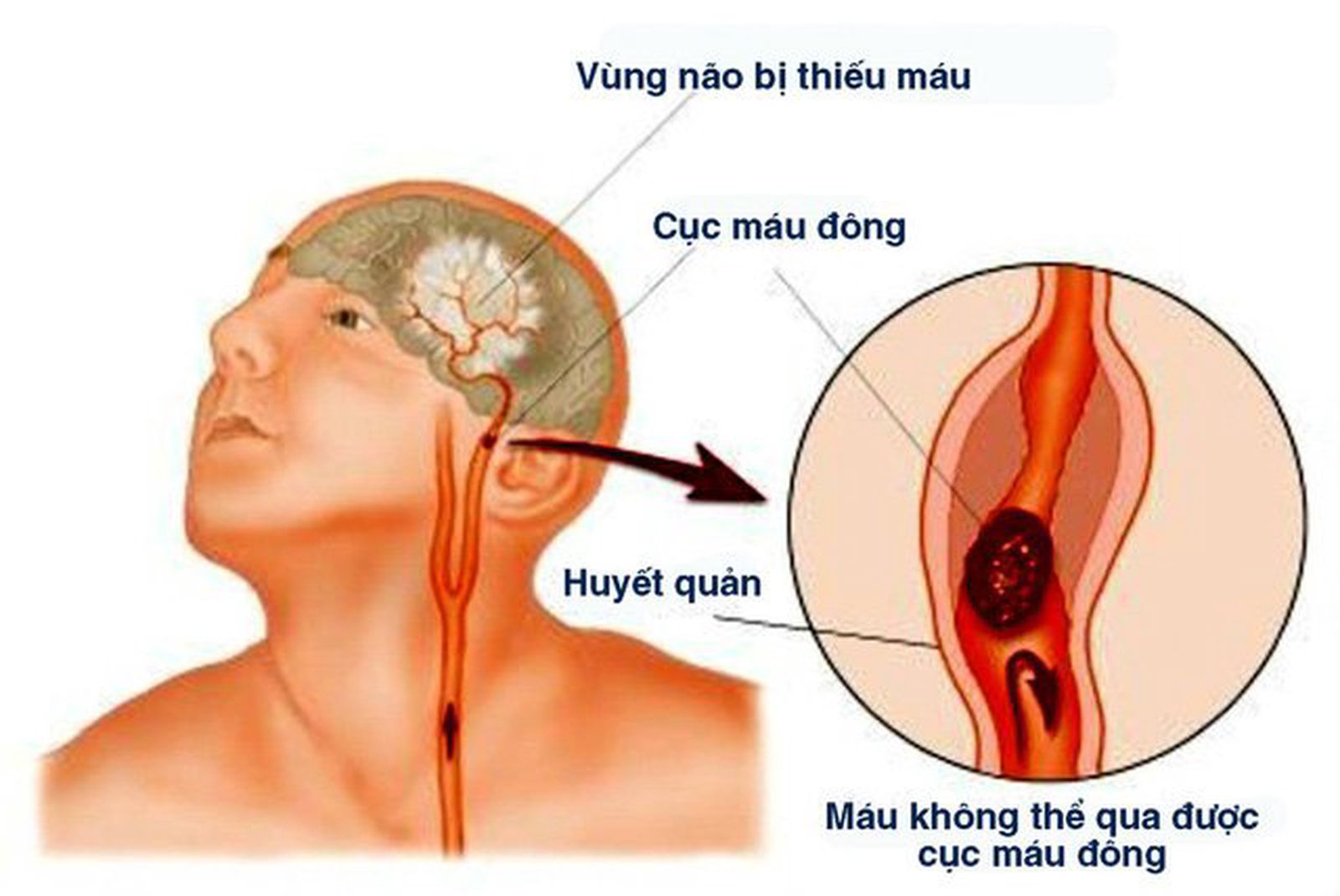 Bệnh nhồi máu não là một dạng của đột quỵ