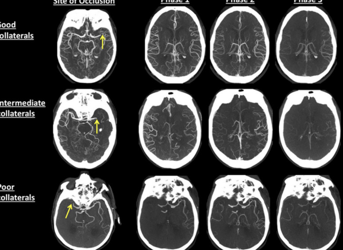 Chụp CT để chẩn đoán nhanh nhồi máu não