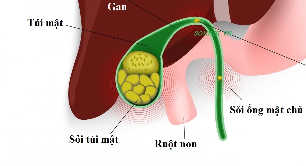 Sỏi mật là nguyên nhân phổ biến nhất gây viêm túi mật ở trẻ em