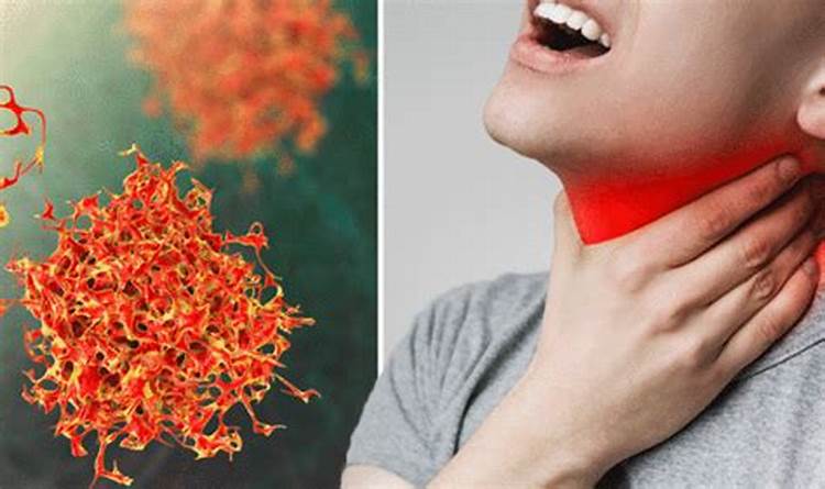 Sự xuất hiện của hạch vùng cổ là dấu hiệu điển hình của ung thư vòm họng giai đoạn 2 