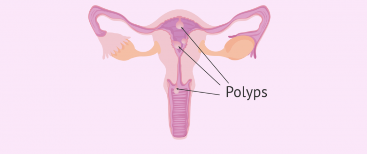 Polyp tử cung là một bệnh lý thường gặp ở phụ nữ