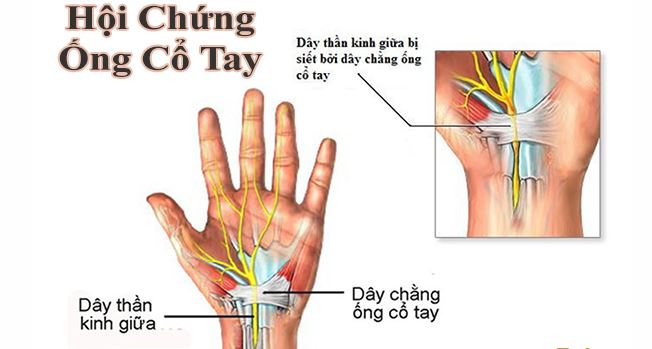 Hình ảnh Hội chứng ống cổ tay.