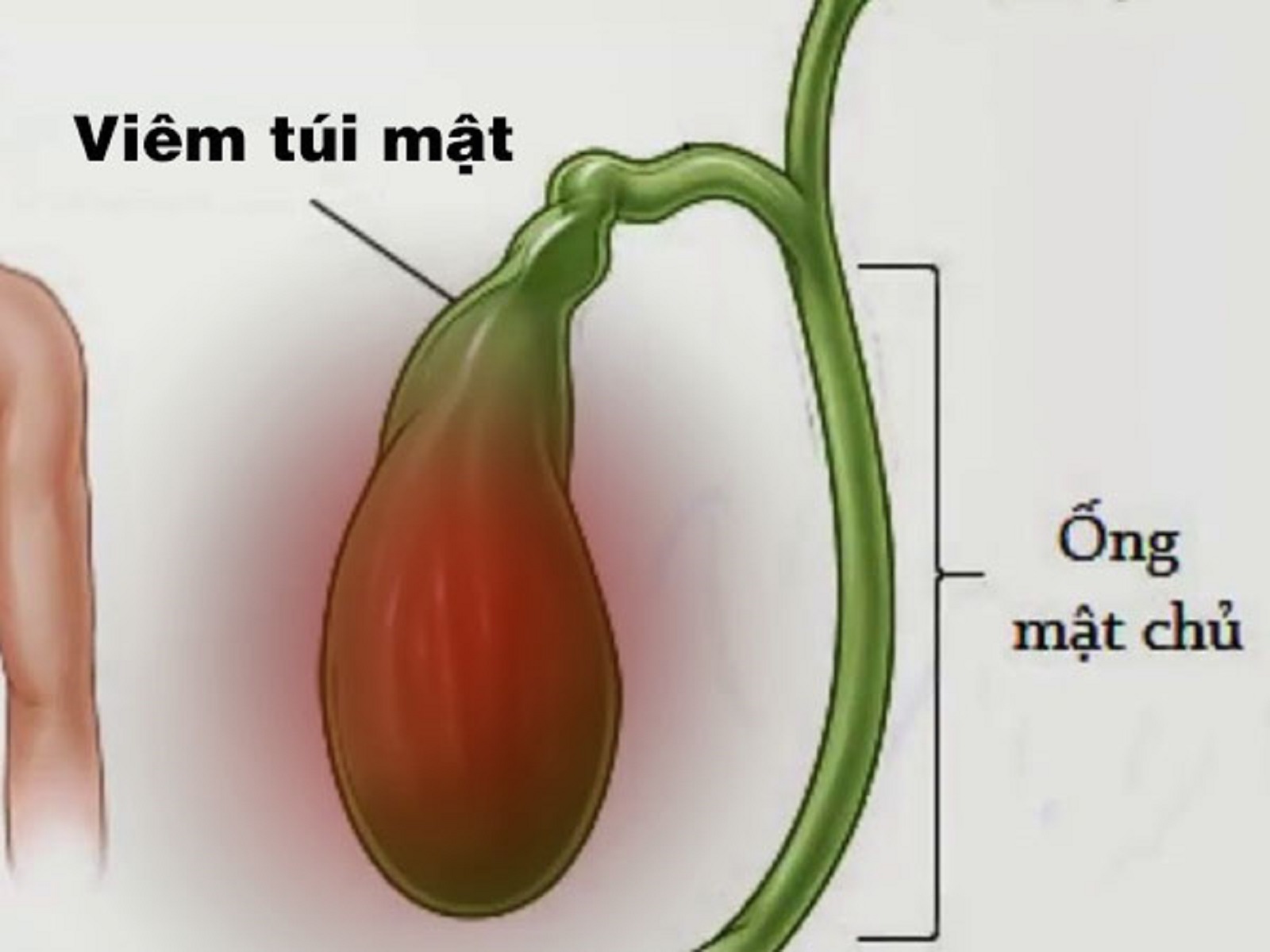 Viêm túi mật