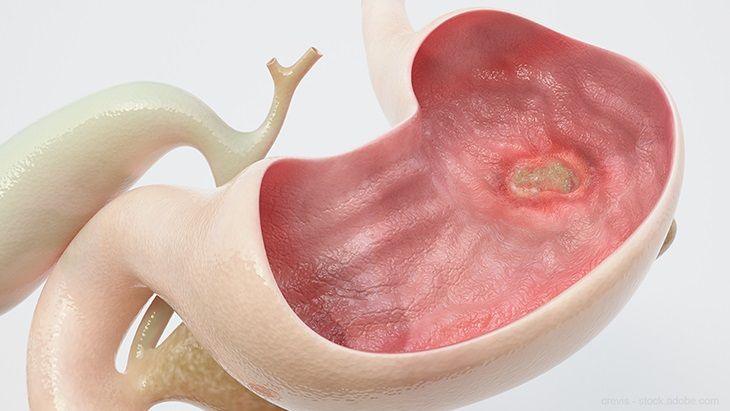 Minh họa vị trí của tá tràng và dạ dày và ruột non trong hệ tiêu hóa đang bị loét Cấu tạo của tá tràng Tá tràng có cấu tạo tương đối phức tạp để phù hợp với vai trò quan trọng trong quá trình tiêu hóa. Thành tá tràng gồm nhiều lớp mô khác nhau, bao gồm lớp niêm mạc, lớp dưới niêm mạc, lớp cơ và lớp thanh mạc. Các lớp này phối hợp với nhau để đảm bảo tá tràng có thể thực hiện hiệu quả chức năng tiêu hóa và vận chuyển thức ăn. Lớp niêm mạc của tá tràng có nhiều nếp gấp và các nhung mao nhỏ. Những cấu trúc này giúp tăng diện tích bề mặt tiếp xúc, từ đó hỗ trợ quá trình hấp thu chất dinh dưỡng. Trên bề mặt niêm mạc còn có các tuyến tiết dịch giúp trung hòa acid từ dạ dày và tạo môi trường thuận lợi cho hoạt động của các enzyme tiêu hóa. Lớp dưới niêm mạc chứa nhiều mạch máu, dây thần kinh và các tuyến tiết dịch. Những tuyến này có nhiệm vụ tiết ra chất nhầy và bicarbonate giúp bảo vệ niêm mạc tá tràng khỏi tác động của acid dạ dày. Bên ngoài lớp dưới niêm mạc là lớp cơ trơn, bao gồm các sợi cơ vòng và cơ dọc. Lớp cơ này giúp tá tràng co bóp nhịp nhàng để trộn thức ăn với dịch tiêu hóa và đẩy hỗn hợp thức ăn xuống các phần tiếp theo của ruột non. Hoạt động co bóp này được gọi là nhu động ruột. Tá tràng được chia thành bốn phần chính gồm phần trên, phần xuống, phần ngang và phần lên. Mỗi phần có vị trí và chức năng riêng nhưng đều góp phần vào quá trình tiêu hóa thức ăn. Phần xuống của tá tràng là nơi đổ vào của ống mật chủ và ống tụy, đưa dịch mật và dịch tụy vào lòng ruột để hỗ trợ tiêu hóa.