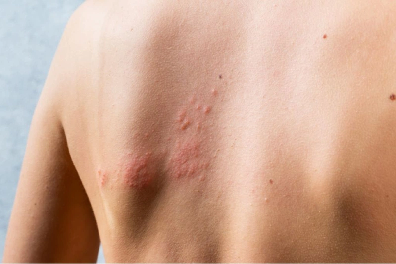 Phát ban HIV là gì? Nguyên nhân, mức độ nguy hiểm và cách xử lý