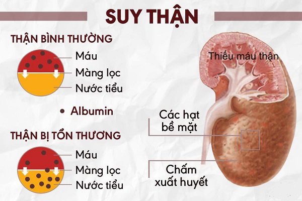 Suy thận mạn là một bệnh lý nghiêm trọng