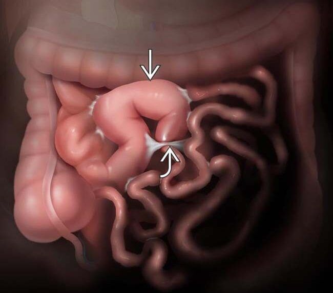 Tắc ruột và những điều cần biết: đừng xem nhẹ dấu hiệu báo động