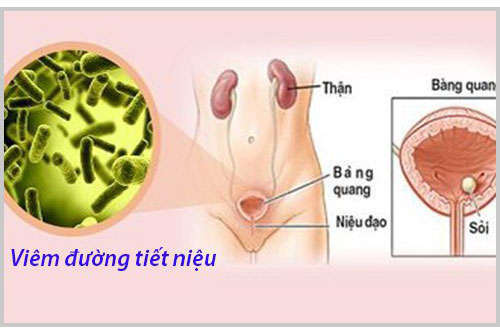 Viêm đường tiết niệu