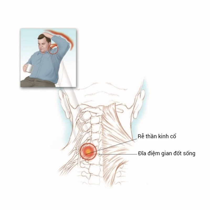 Triệu chứng rễ thần kinh