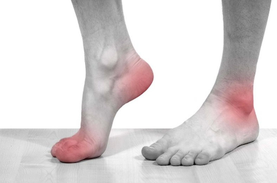 Củ Ráy là vị thuốc điều trị bệnh Gout