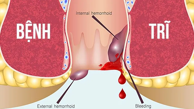 Phương pháp Longo là bước đột phá giúp điều trị trĩ vòng hiệu quả và ít đau đớn