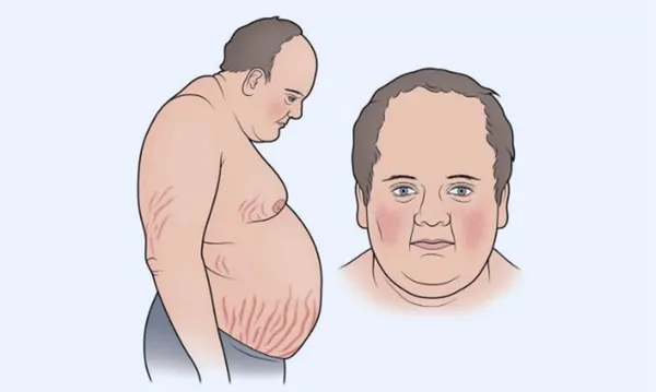 Phụ nữ trong độ tuổi trung niên có nguy cơ mắc hội chứng Cushing nội sinh cao hơn so với nam giới