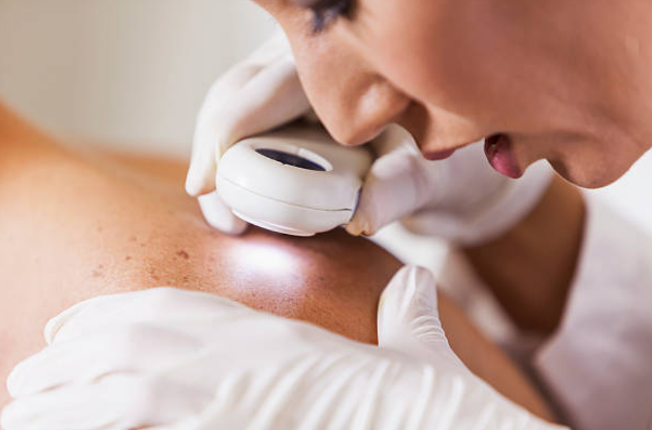 Khả năng chữa khỏi ung thư da là rất cao nếu được can thiệp ở giai đoạn đầu