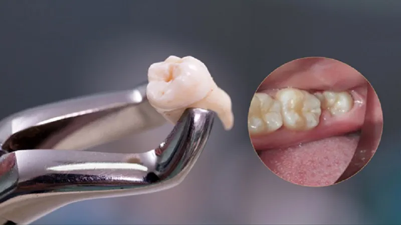 Hình minh họa nhổ răng ở người tiểu đường