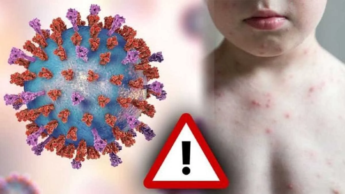 Virus là tác nhân gây bệnh sởi và Rubella