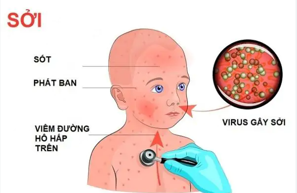 Triệu chứng của bệnh sởi