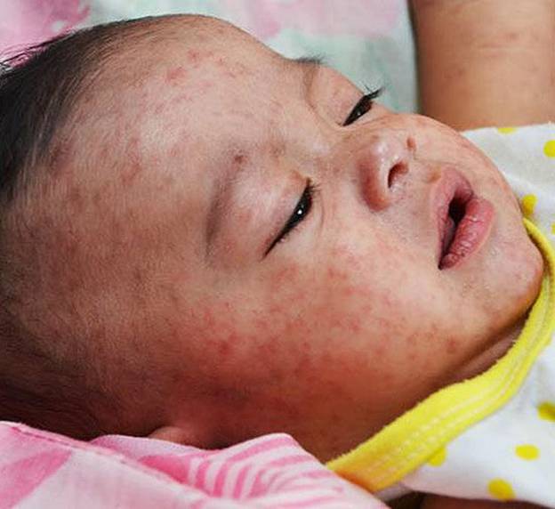 Bệnh rubella ở trẻ em