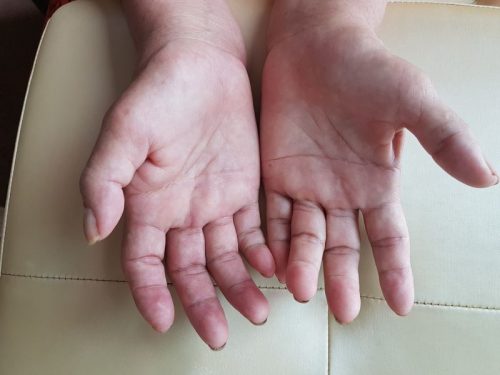 Triệu chứng hội chứng Sudeck