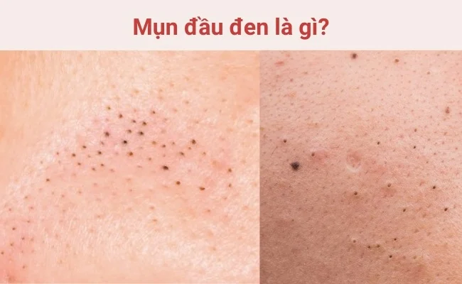 Mụn đầu đen là gì?