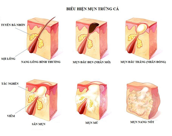                                               Các dấu hiệu mụn trứng cá