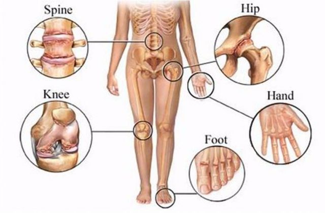 1. Thoái Hóa Đa Khớp Là Gì?