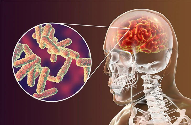 Viêm màng não có thể do nhiều nguyên nhân, trong đó mô cầu khuẩn là nguyên nhân thường gặp nhất