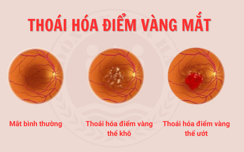Thoái hóa điểm vàng: nguyên nhân, triệu chứng và phương pháp điều trị
