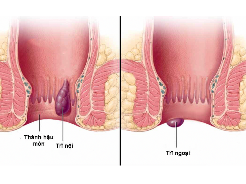 Phân biệt trĩ nội và trĩ ngoại