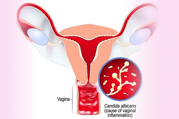 Khi nấm Candida albicans phát triển quá mức sẽ dẫn đến tình trạng nấm âm đạo