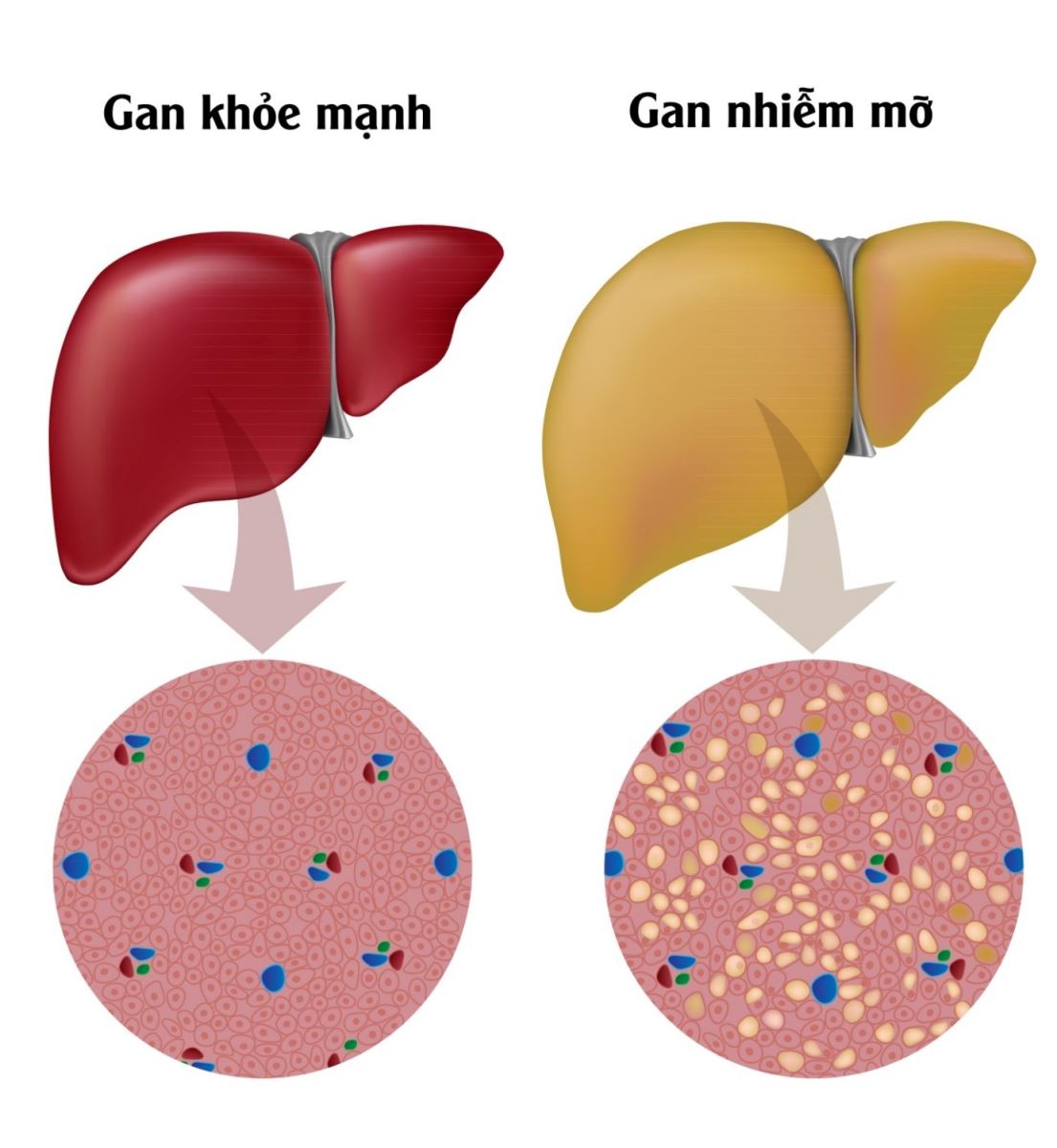   Gan nhiễm mỡ