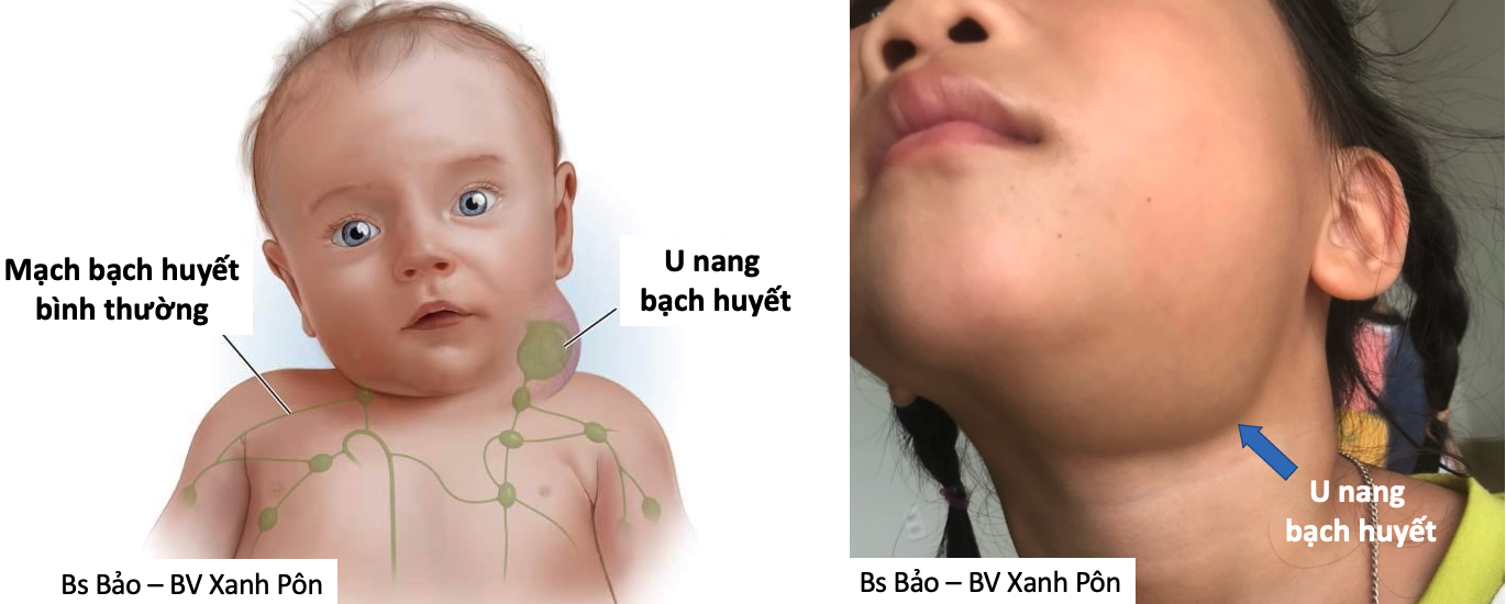 U nang bạch huyết ở trẻ sơ sinh: Nguyên nhân, triệu chứng và điều trị hiệu quả