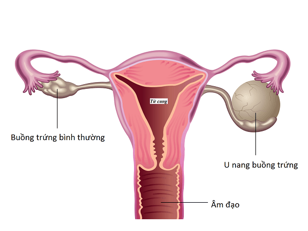 U nang buồng trứng