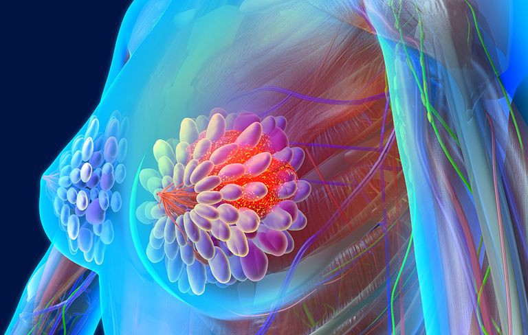 Điều trị nội tiết thường mang lại hiệu quả cao đối với ung thư vú thể nhú