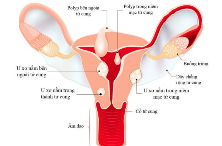 U xơ tử cung