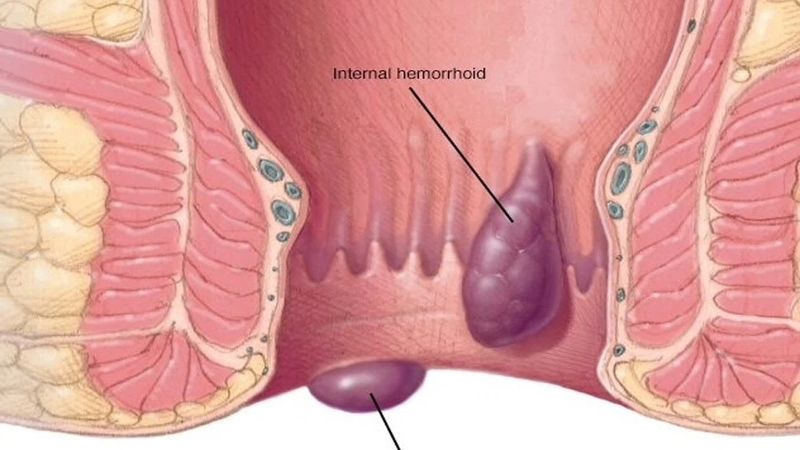 Thói quen ngồi lâu và ít vận động là yếu tố nguy cơ hàng đầu dẫn đến tắc mạch trĩ